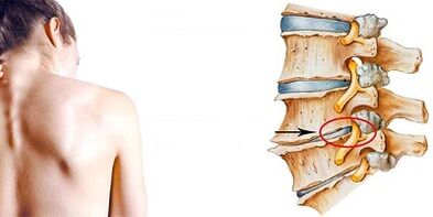 Le mécanisme de développement de l'ostéochondose cervicale