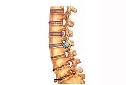 Phase de développement de l'ostéochondose cervicale