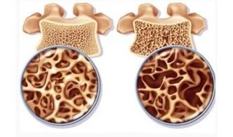 Danger d'aspiration cervicale pour les femmes