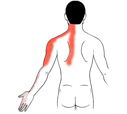 ostéochondrose cervicale comme cause de douleur dans les articulations des doigts