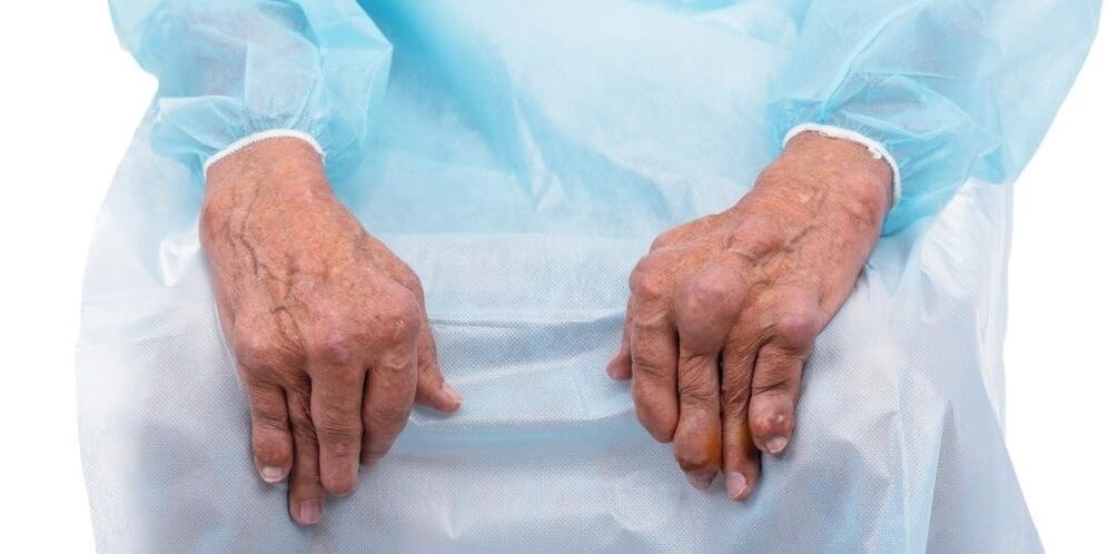 L'arthrite infectieuse est une maladie caractérisée par une douleur constante et des modifications des articulations des doigts.