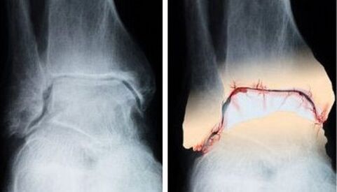 articulation saine et arthritique